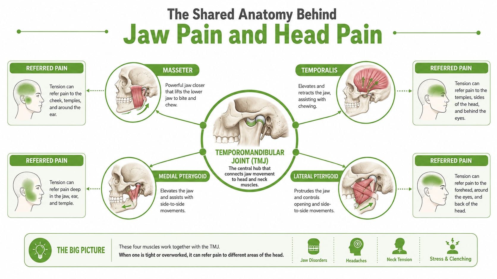 A diagram illustrating how tension in four jaw muscles refers pain to different areas of the head.